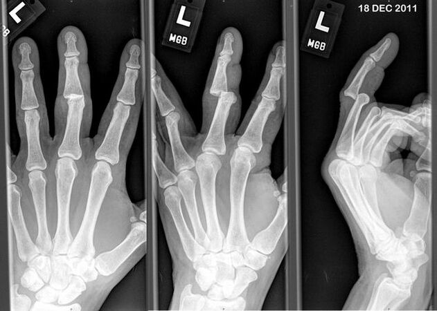 Izmežģīto pirkstu rentgens