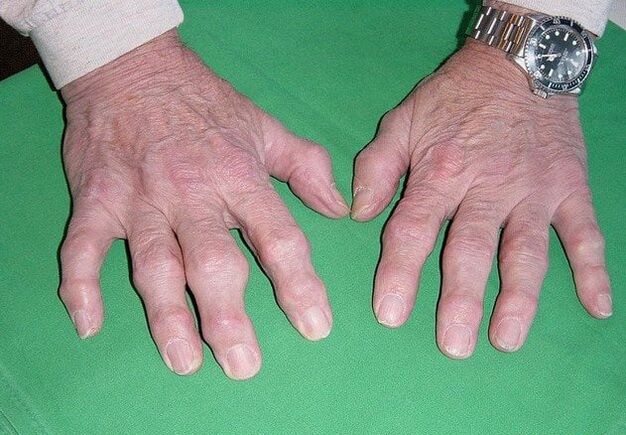 Pirkstu osteoartrīts