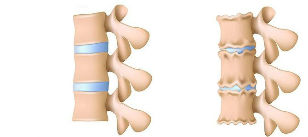 Osteohondrozes attīstības mehānisms