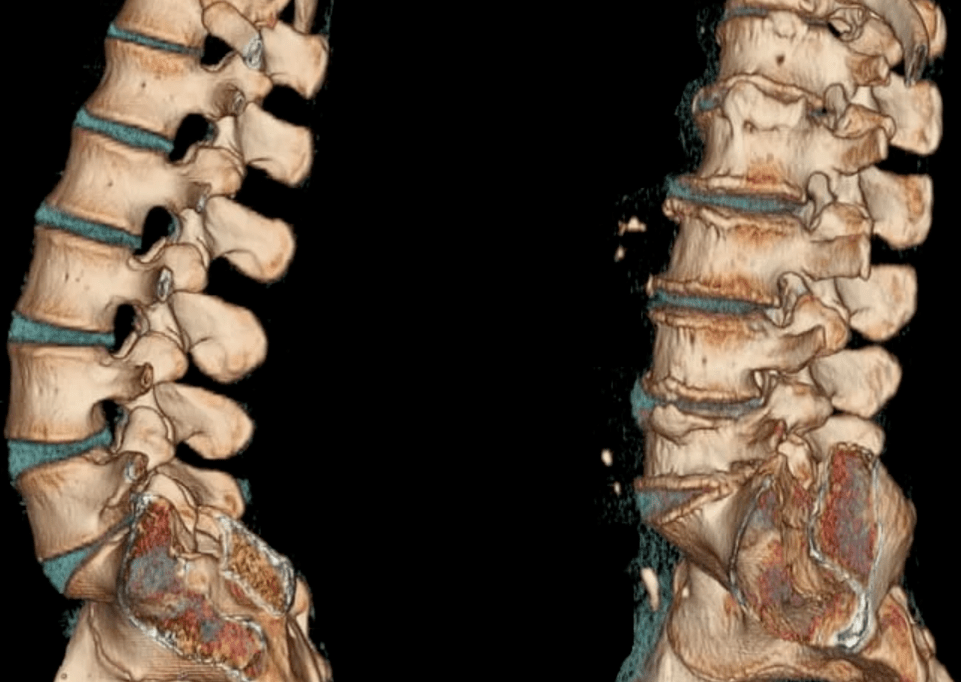 osteohondroze