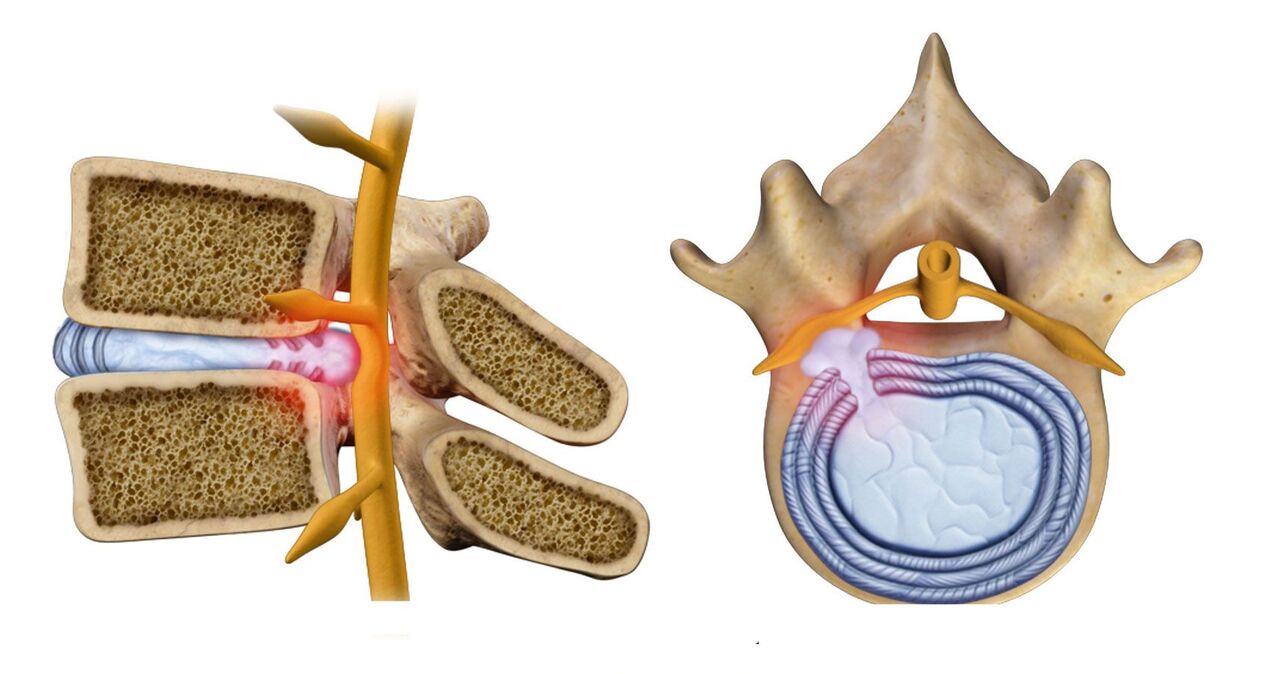 mugurkaula trūce krūšu kurvja osteohondrozes gadījumā