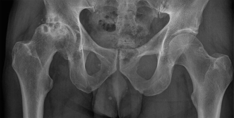 Deformējošā gūžas locītavas artroze rentgenā