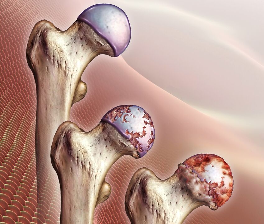 Gūžas locītavas artrozes attīstība