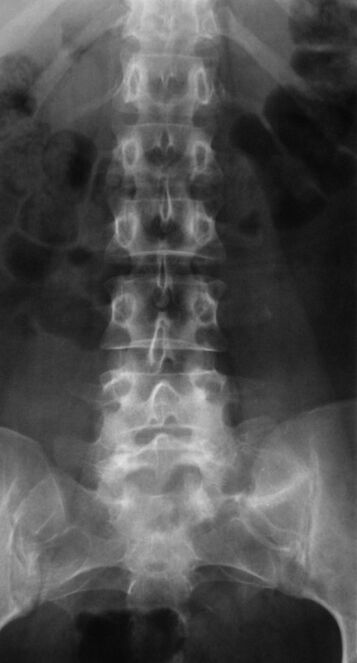 Lai diagnosticētu jostas daļas osteohondrozi, tiek veikta radiogrāfija